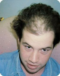 Man with thinning hair, looking at the camera, wearing a blue shirt.