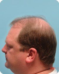 Man with thinning brown hair, profile view, against a blue background.
