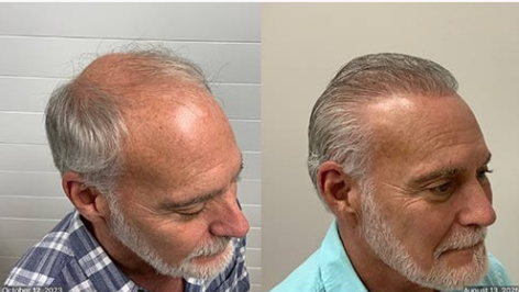 Before and after comparison of hair restoration showing a fuller hairline and increased hair density on the scalp.