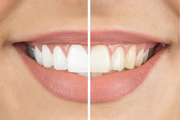 happy teeth whitening patient