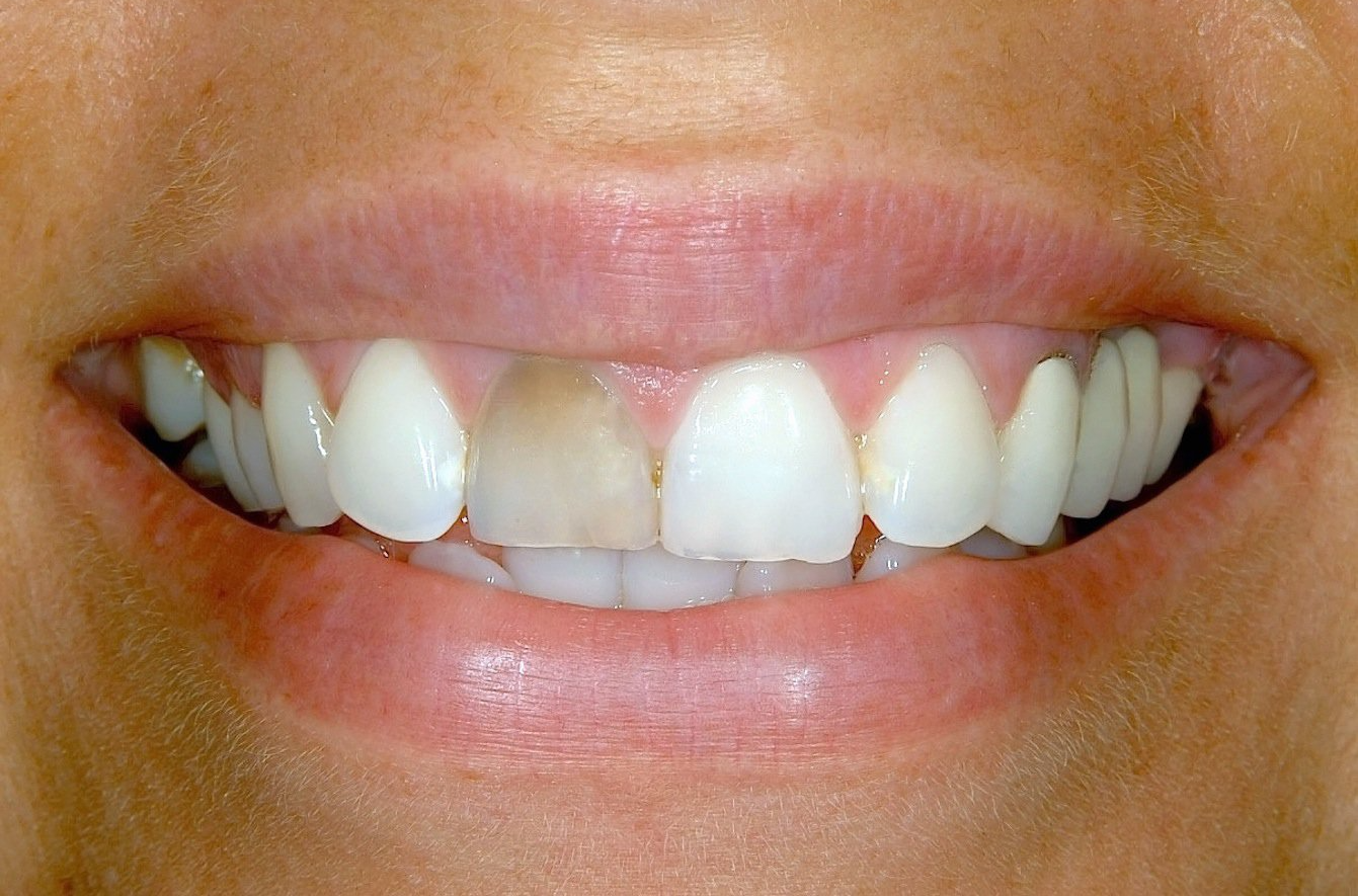 veneers before