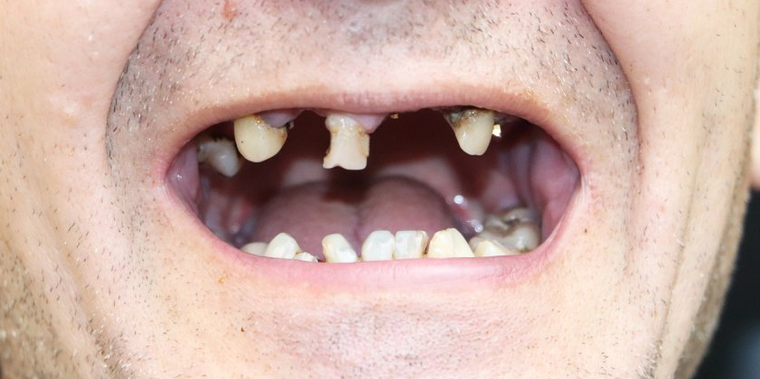 before implant Sunland Dental