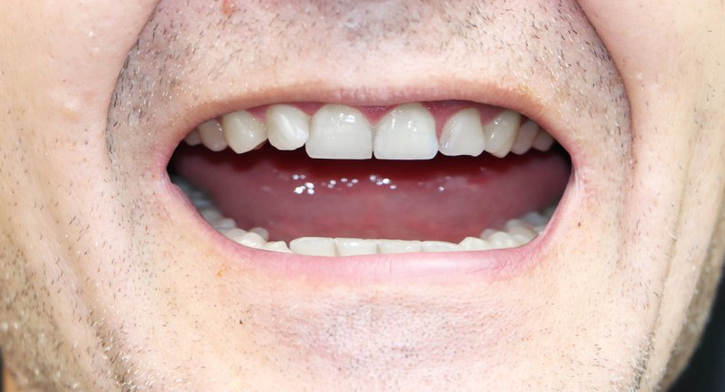 after implant Sunland Dental