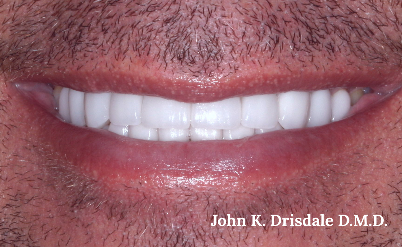 A close up of a man 's mouth with white teeth by john k. driscole d.m.d.