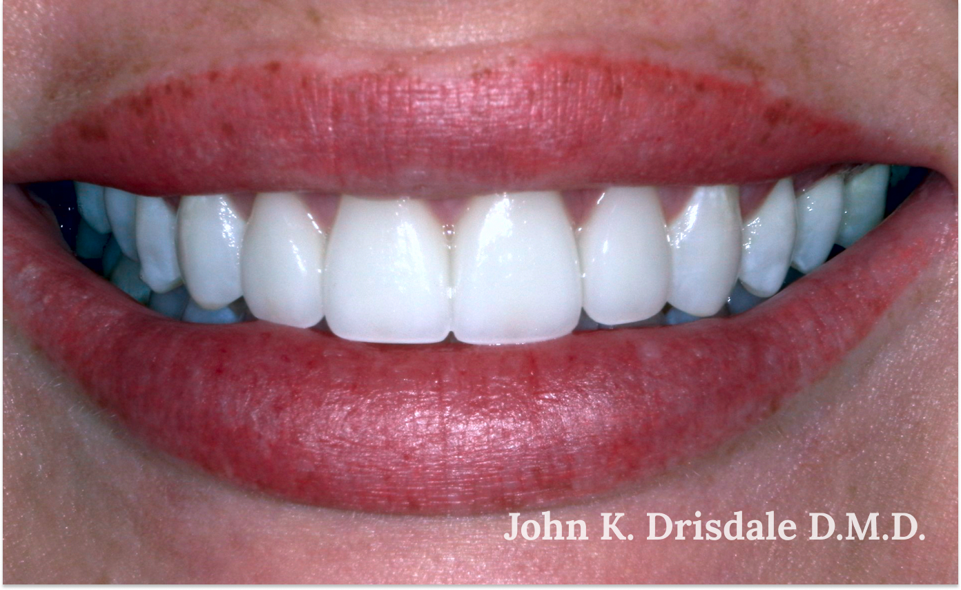 A close up of a woman 's teeth by john k. driscole d.m.d.