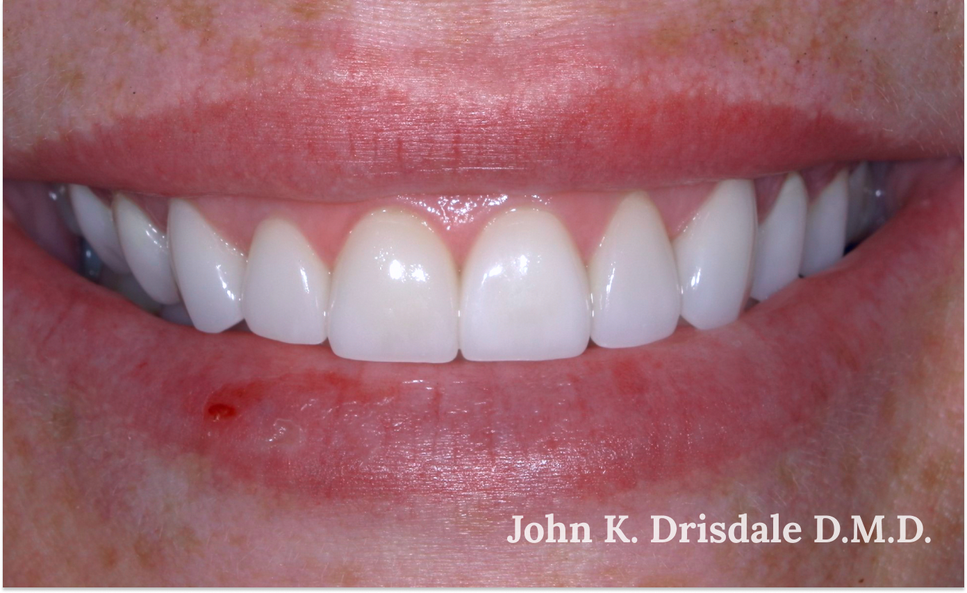 A close up of a woman 's teeth by john k. driscole d.m.d.