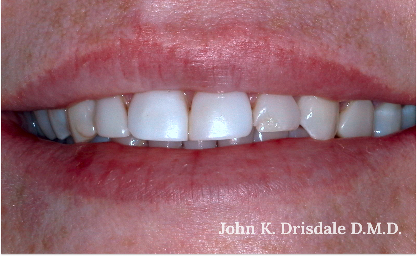 A close up of a woman 's teeth by john k. driscole d.m.d.