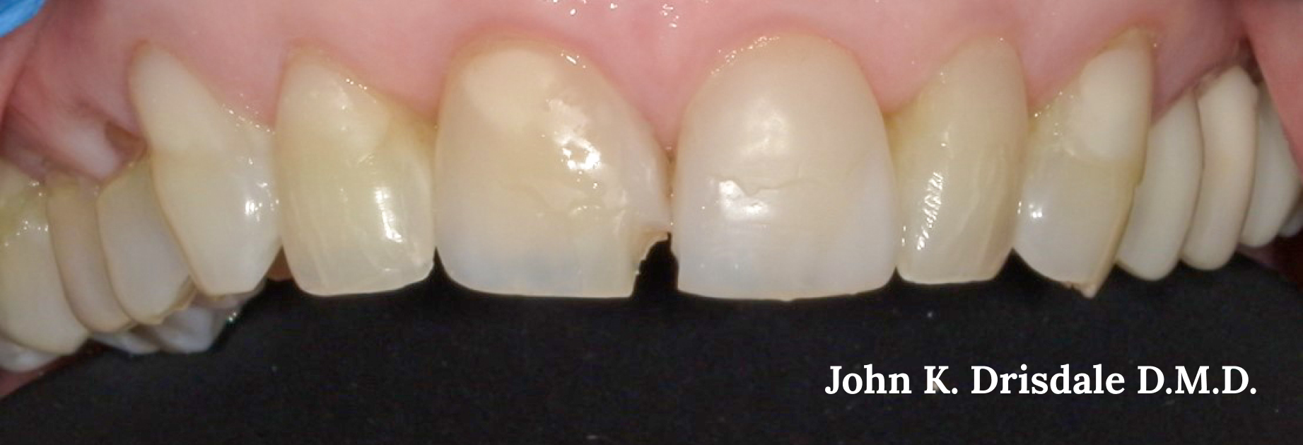A close up of a person 's teeth by john k. driscoll d.m.d.