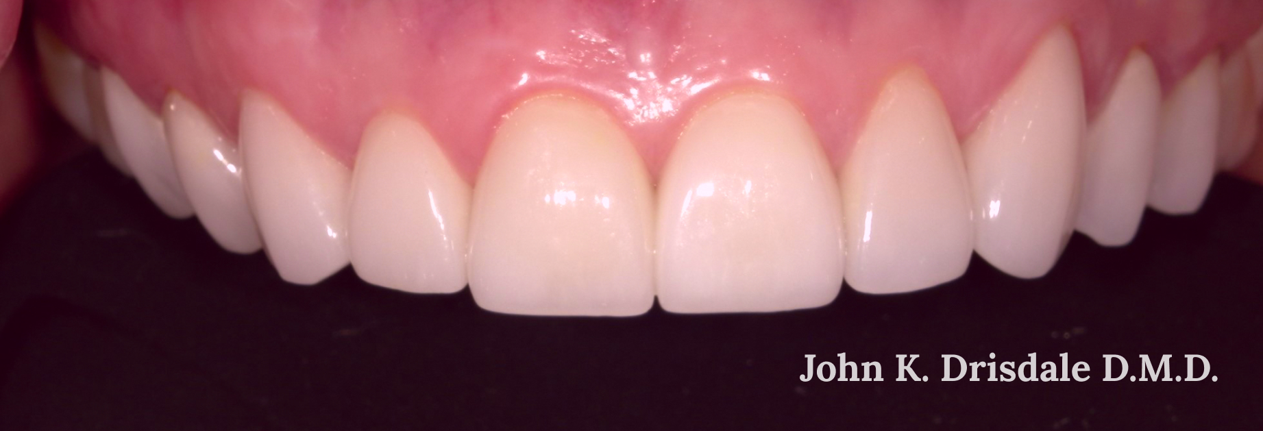 A close up of a person 's teeth by john k. driscole d.m.d.