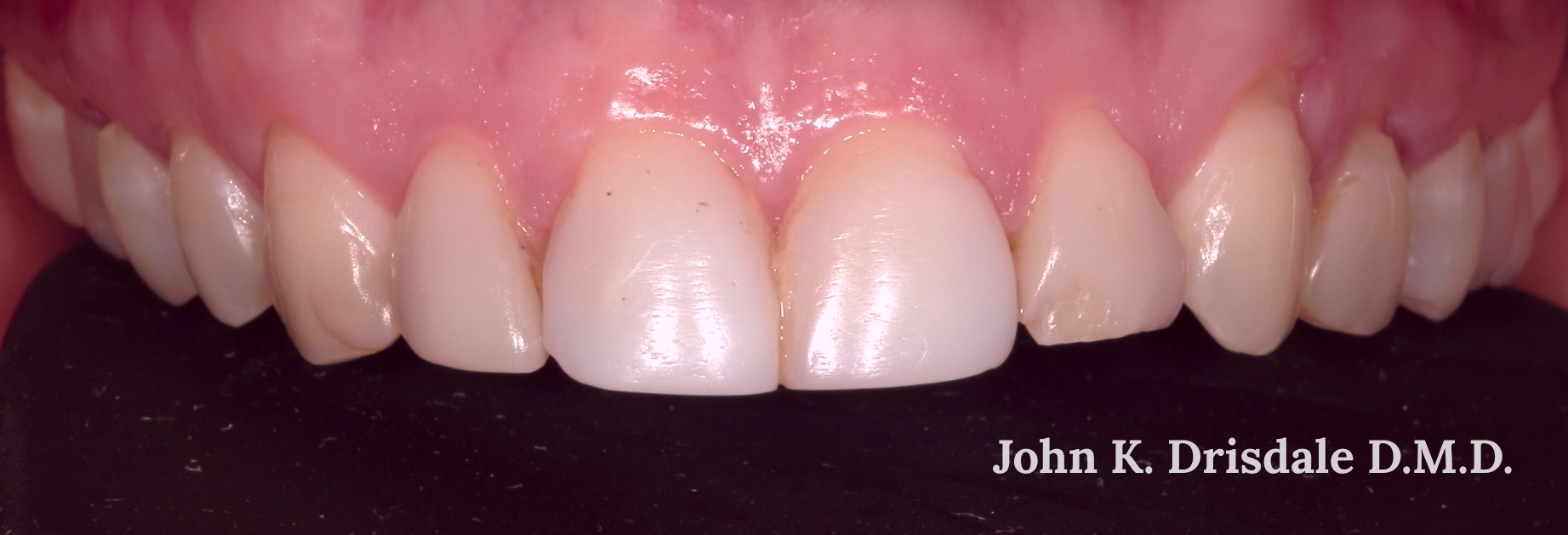 A close up of a person 's teeth taken by john k. driscole d.m.d.