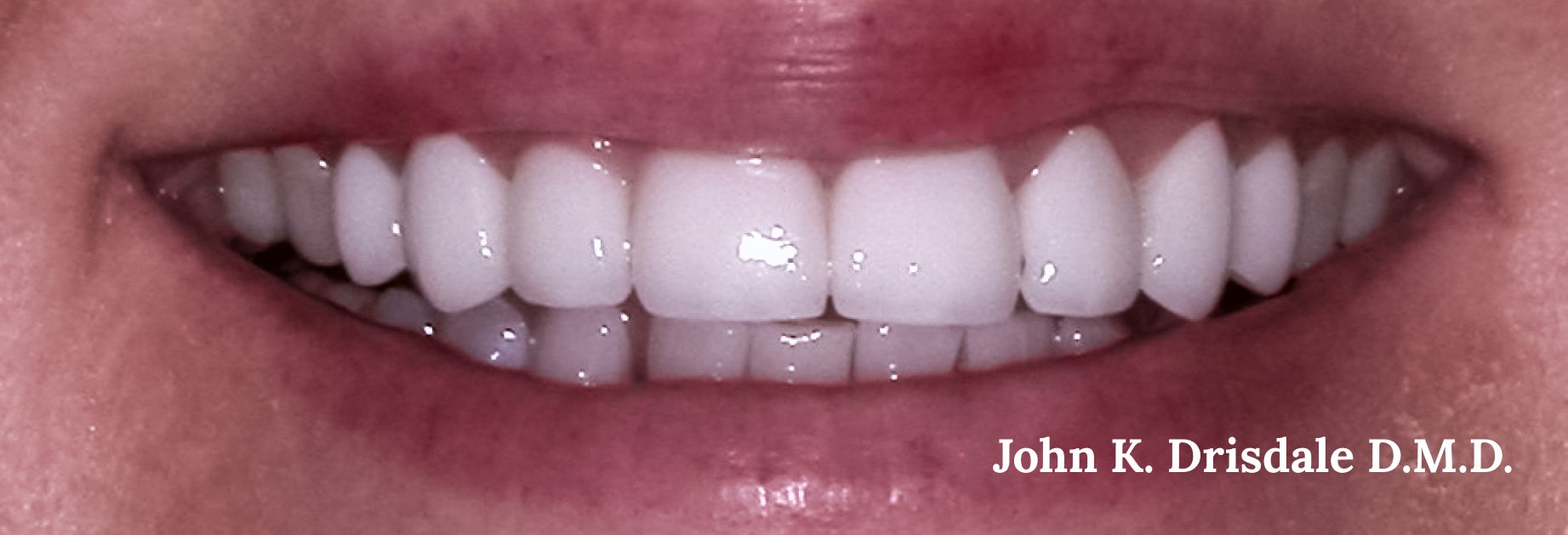 A close up of a woman 's teeth by john k. driscole d.m.d.