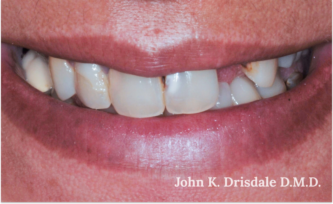 A close up of a person 's teeth taken by john k. driscole d.m.d.