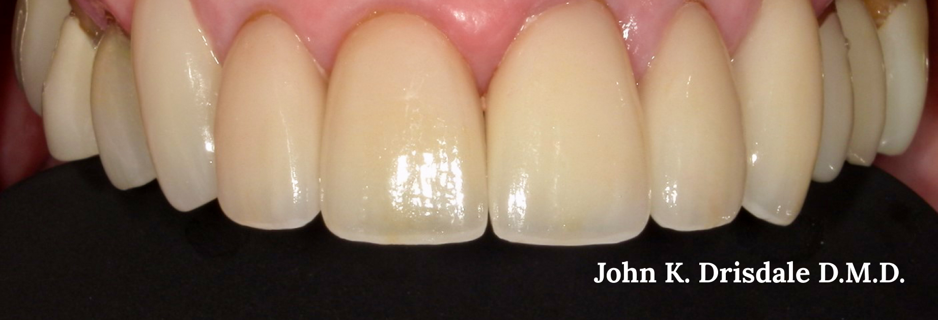 A close up of a person 's teeth by john k. driscoll d.m.d.