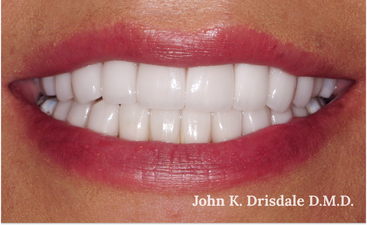 A close up of a woman 's teeth by john k. driscole d.m.d.