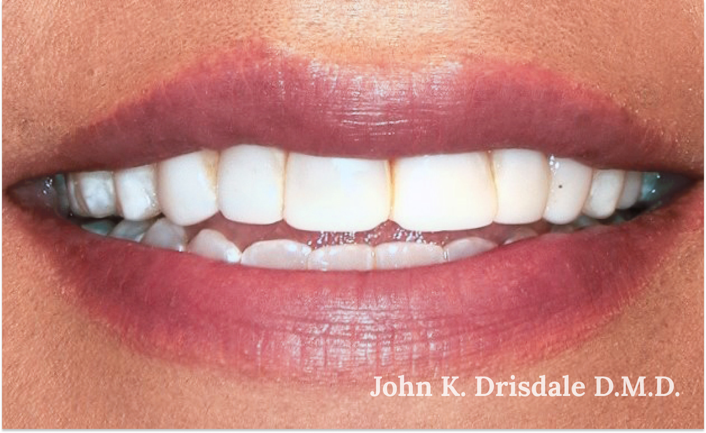 A close up of a woman 's teeth by john k. driscole d.m.d.