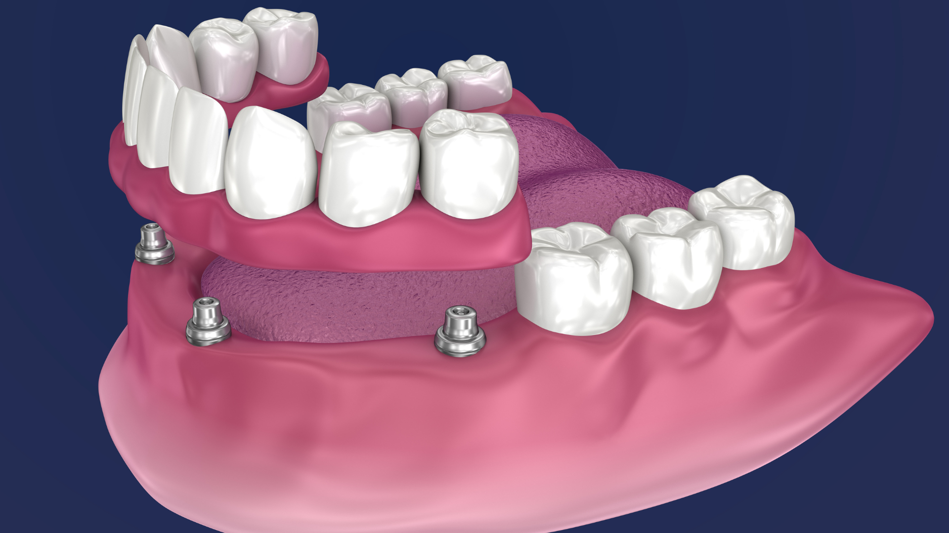 Gum Grafting in Midland, TX