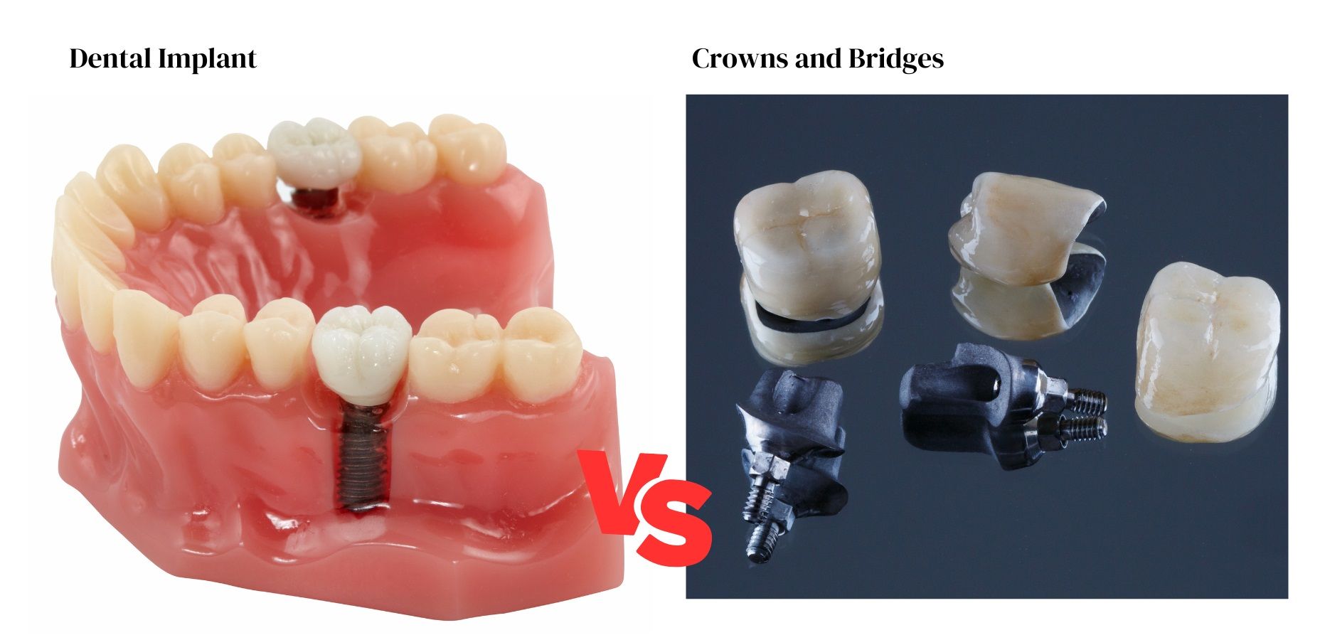 A picture of dental implants and crowns and bridges