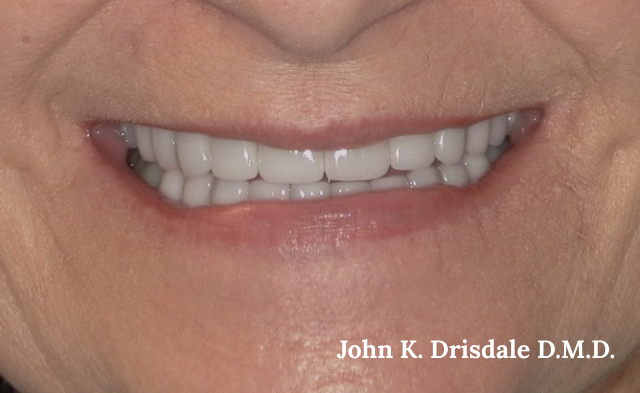 White smile after teeth whitening