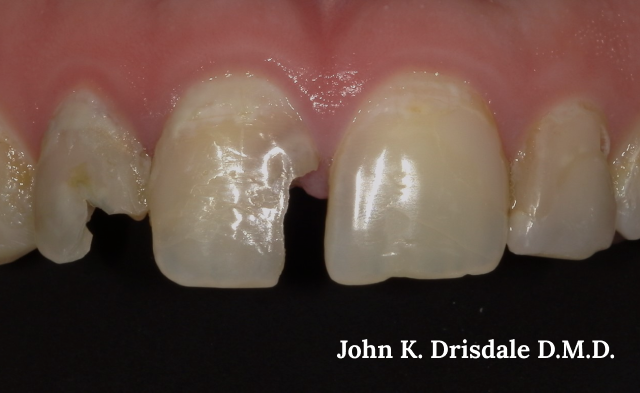 A close up of a person 's teeth with a broken tooth.