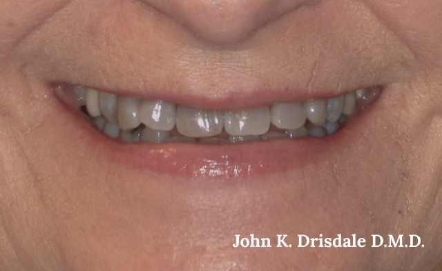 Yellowed smile before teeth whitening