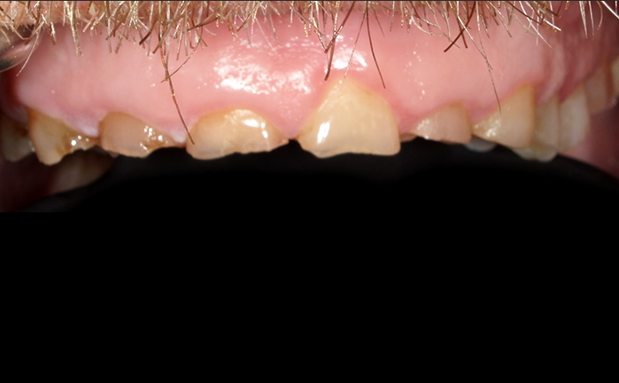 A close up of a person 's teeth with a broken tooth.