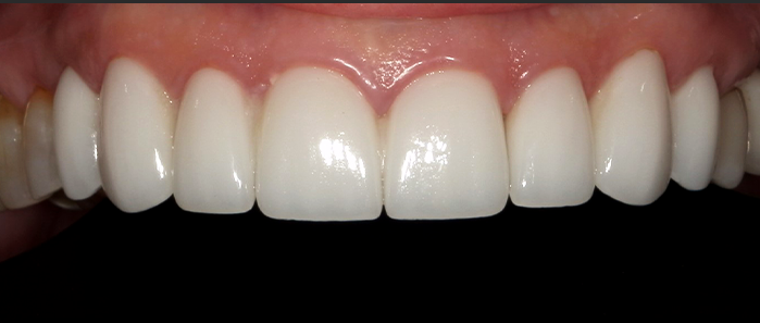 A close up of a person 's teeth by john k. drisdale d.m.d.