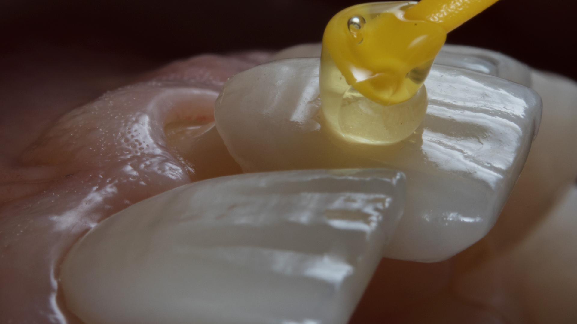 a close up of a tooth with a yellow object on it .