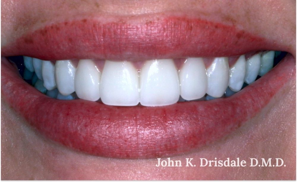 After photo, four-veneer case