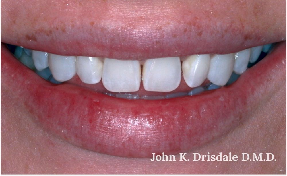 Before photo, four-veneer case