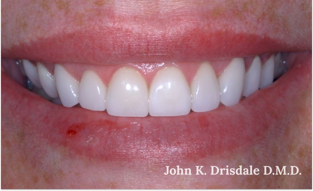 After photo, ten-veneer case