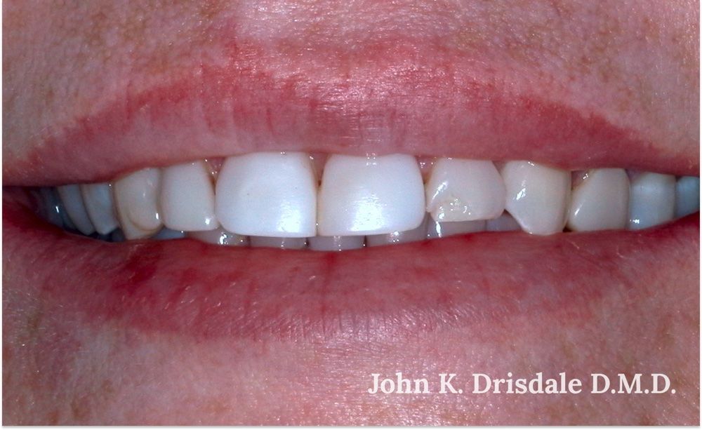Before photo, ten-veneer case