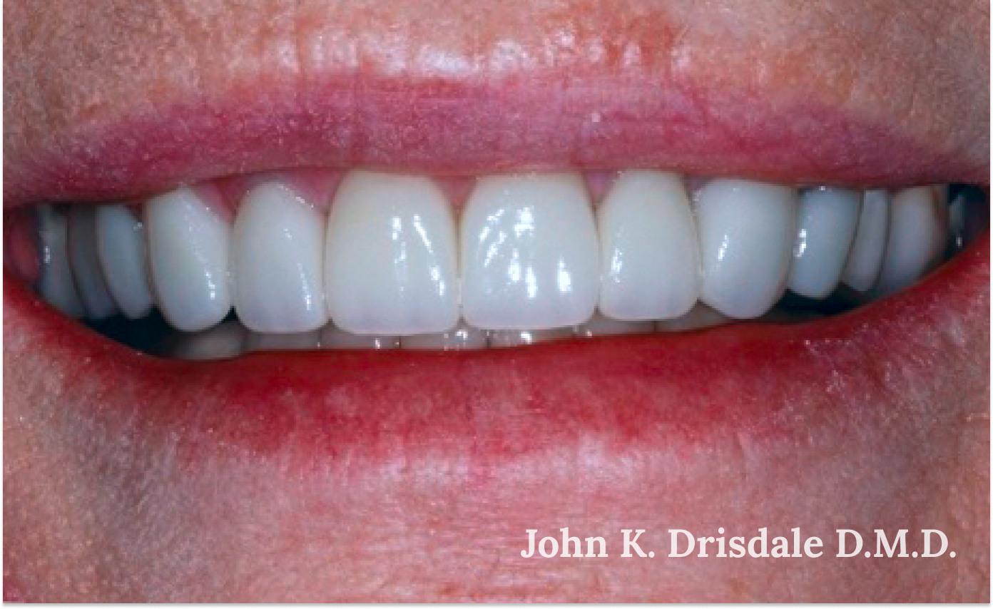 A close up of a woman 's teeth by john k. driscole d.m.d.