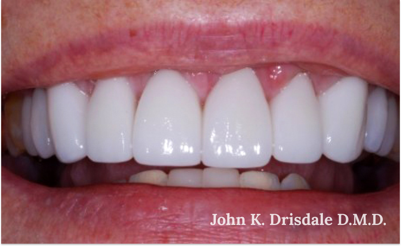 A close up of a person 's teeth by john k. driscole d.m.d.