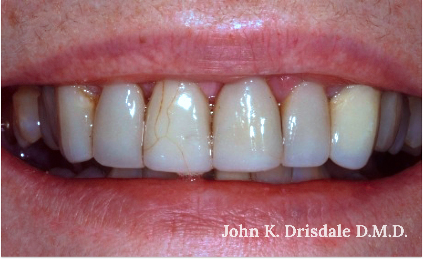 A close up of a person 's teeth taken by john k. driscole d.m.d.