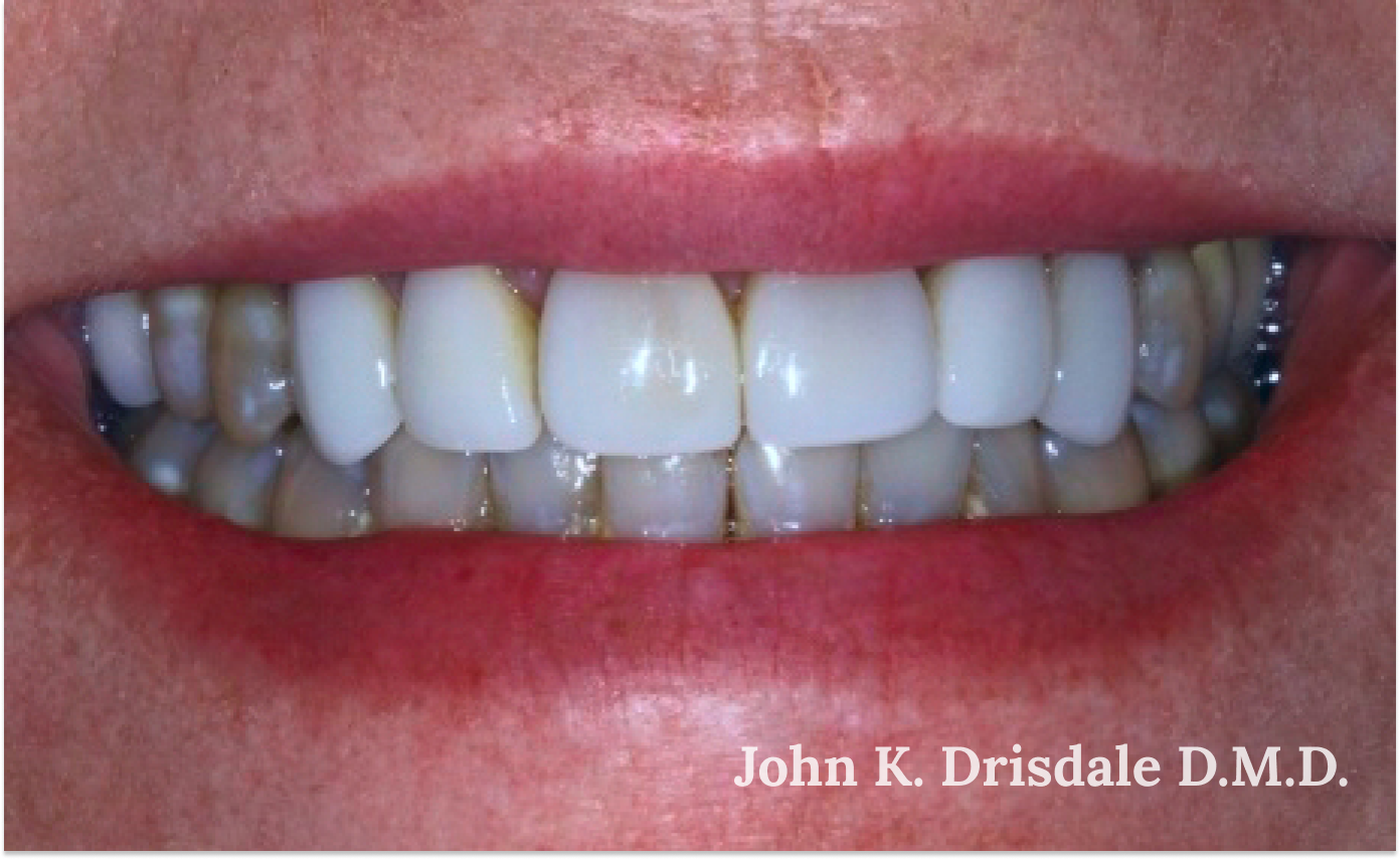 A close up of a person 's teeth taken by john k. driscole d.m.d.