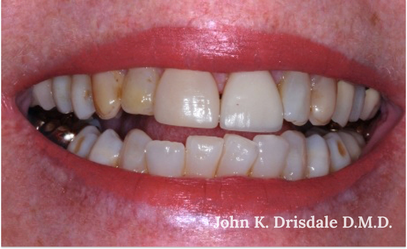 A close up of a person 's teeth taken by john k. driscole d.m.d.