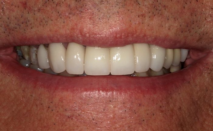A close up of a man 's teeth by john k. driscole d.m.d.