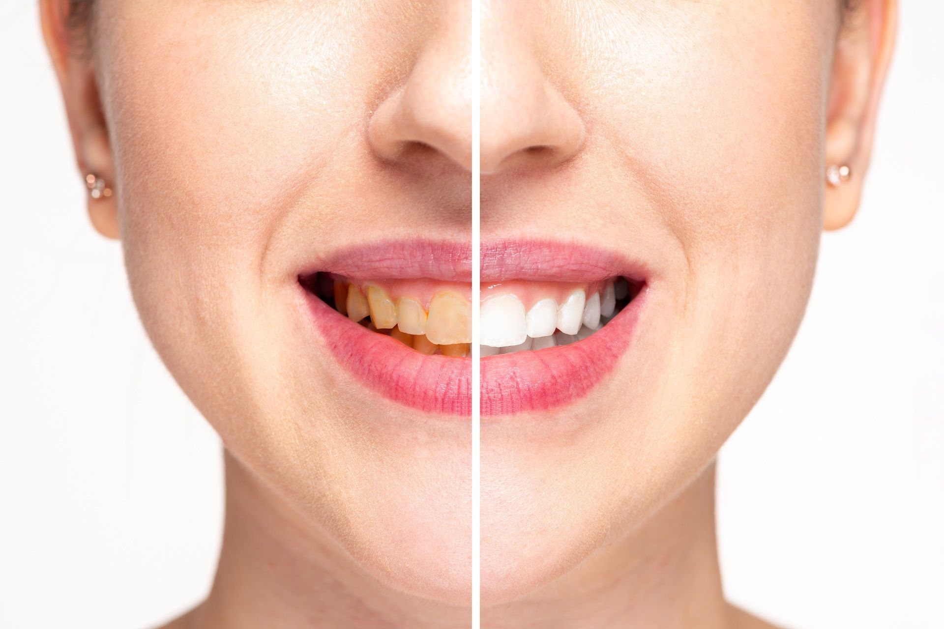 A woman 's teeth before and after whitening.