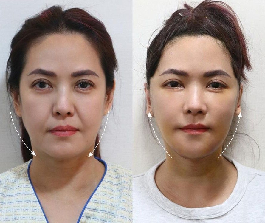 Deep plane facelift result Gangnam
