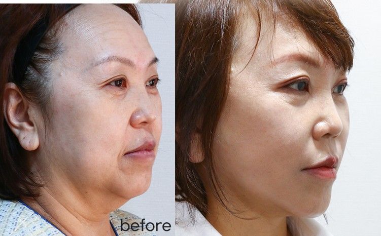 Face and neck lift result Korea