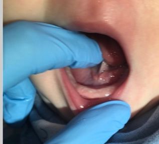a person wearing blue gloves is examining a child 's teeth 