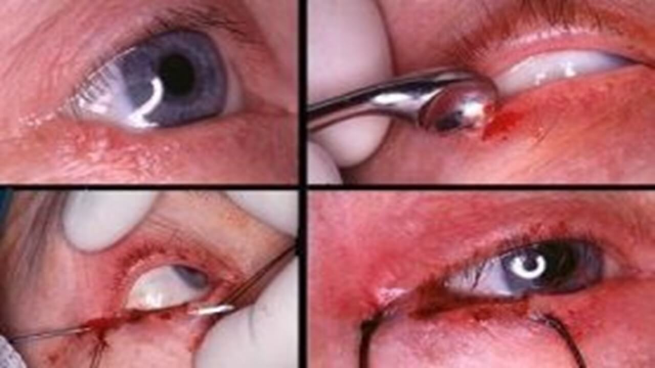 DR. RICARDO RAMOS - trasplante corneal