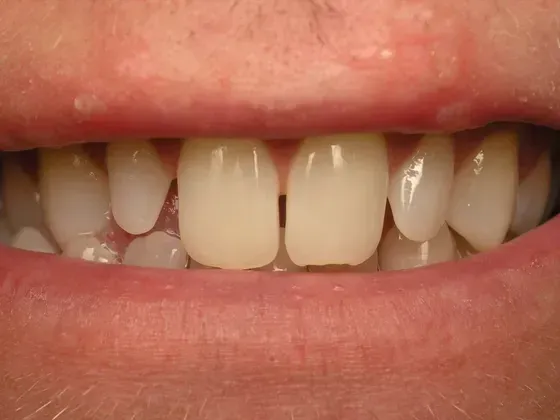 A close up of a person 's teeth and lips. A close up of a person 's teeth and lips.