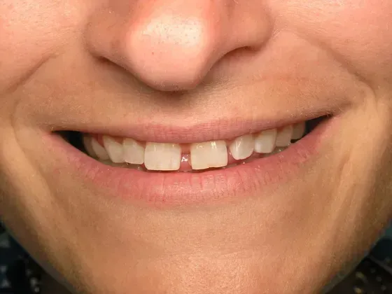 A close up of a woman 's smile with missing teeth. A close up of a woman 's smile with missing teeth.