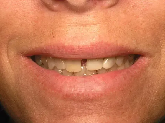 A close up of a woman 's mouth with a missing tooth. A close up of a woman 's mouth with a missing tooth.