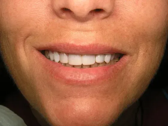 A close up of a woman 's smile with white teeth. A close up of a woman 's smile with white teeth.