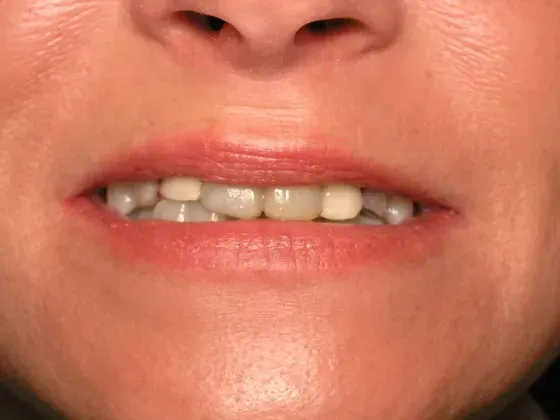 A close up of a woman 's mouth and teeth. A close up of a woman 's mouth and teeth.