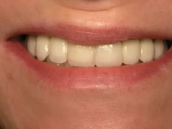 A close up of a woman 's smile with white teeth. A close up of a woman 's smile with white teeth.