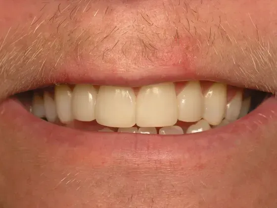 A close up of a man 's mouth with white teeth. A close up of a man 's mouth with white teeth.