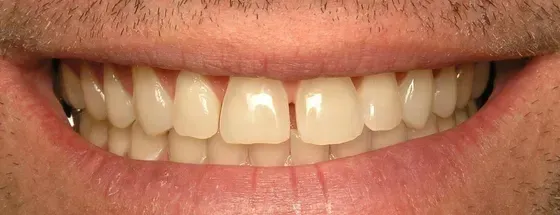 A close up of a man 's teeth with a beard. A close up of a man 's teeth with a beard.